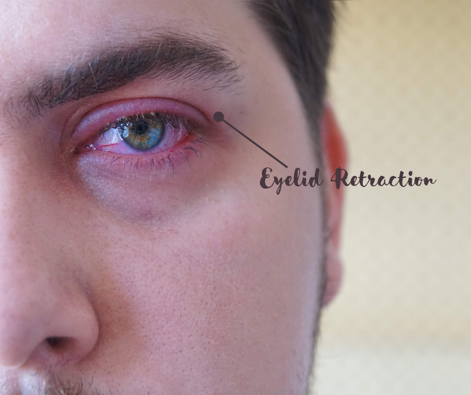 Eyelid Retraction & Scarring: Causes and Treatment Methods