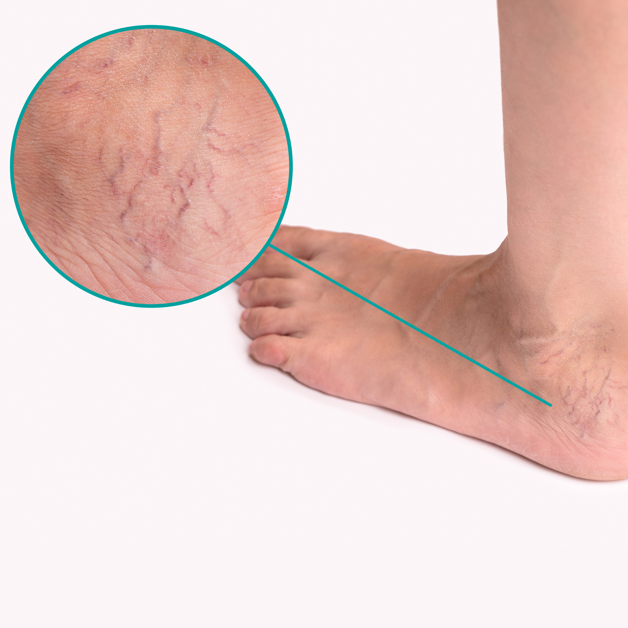 Spider Veins: Causes, Prevention and How to Treat them