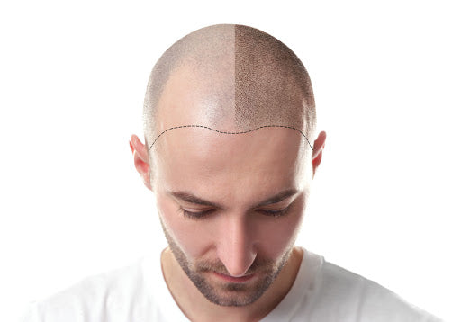 Hair Transplant Scars Removal: How Effective Is It?