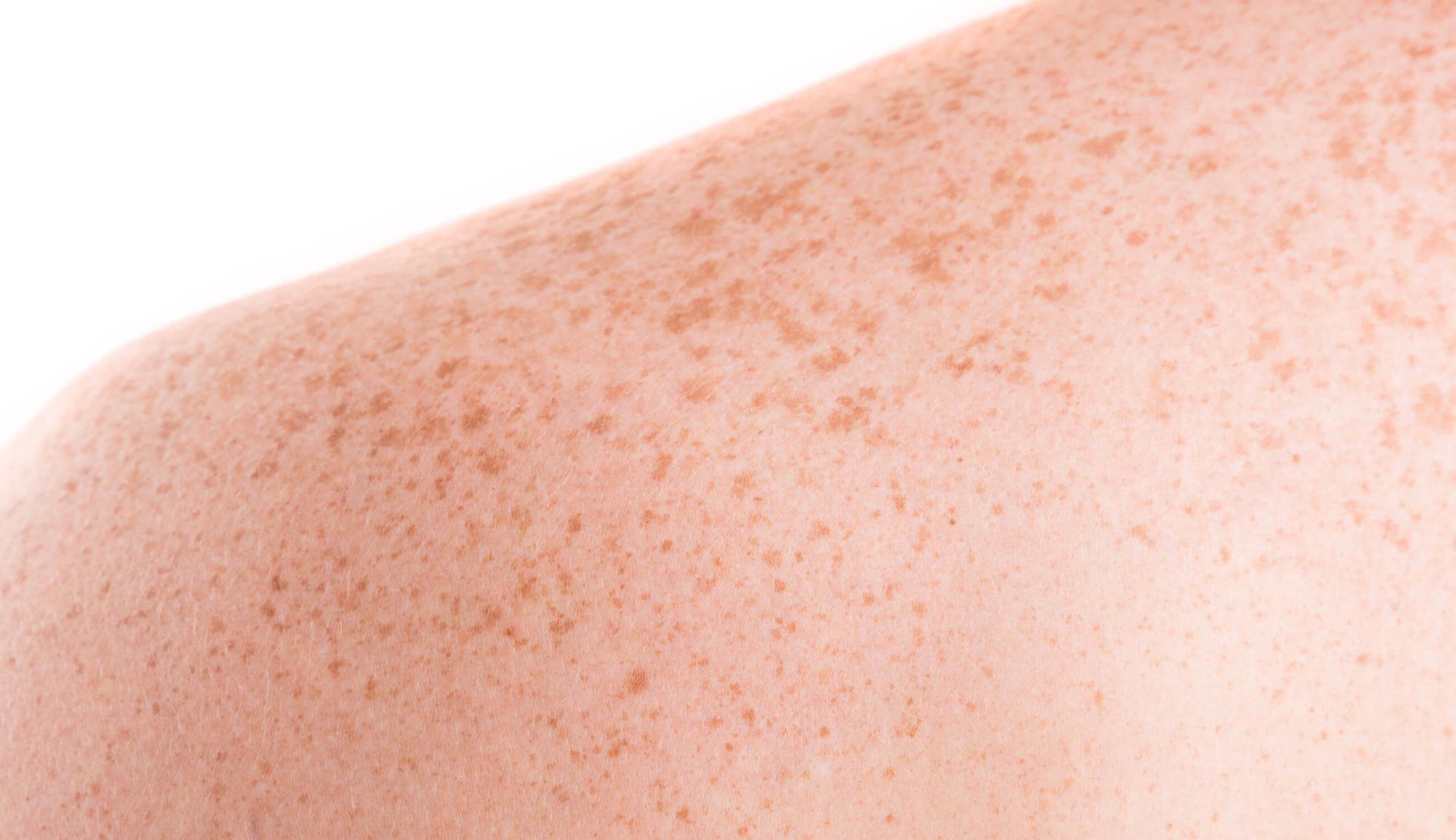 How to Remove Dark Spots from your Body: Causes, and Prevention