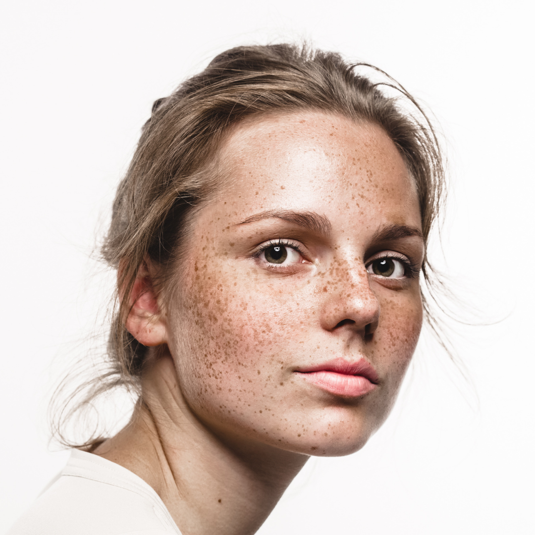 Freckles on the Face: Why They Appear, and How to Get Rid of Them