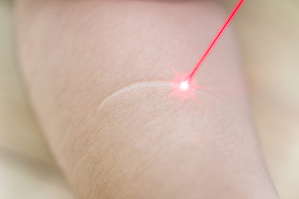 Laser Treatment for Keloids: Get the Best Results