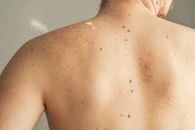Moles on the Body: Frequently Asked Questions about Moles