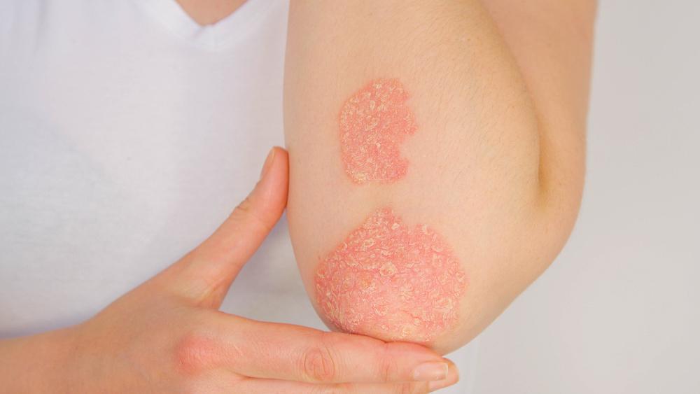 Psoriasis Scar Treatment: How Psoriasis Scars Form, and their Remedies