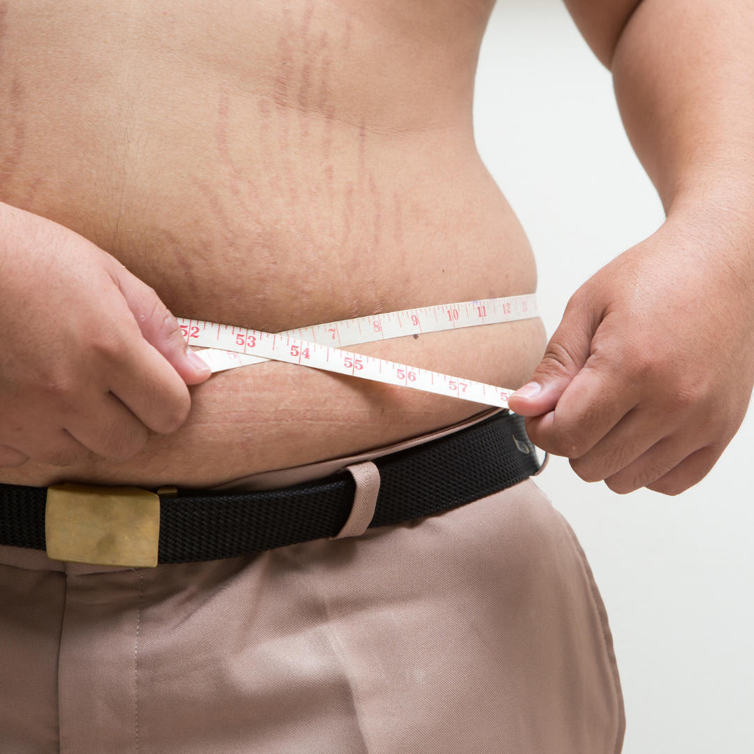 Stretch Marks in Men: What you Need to Know