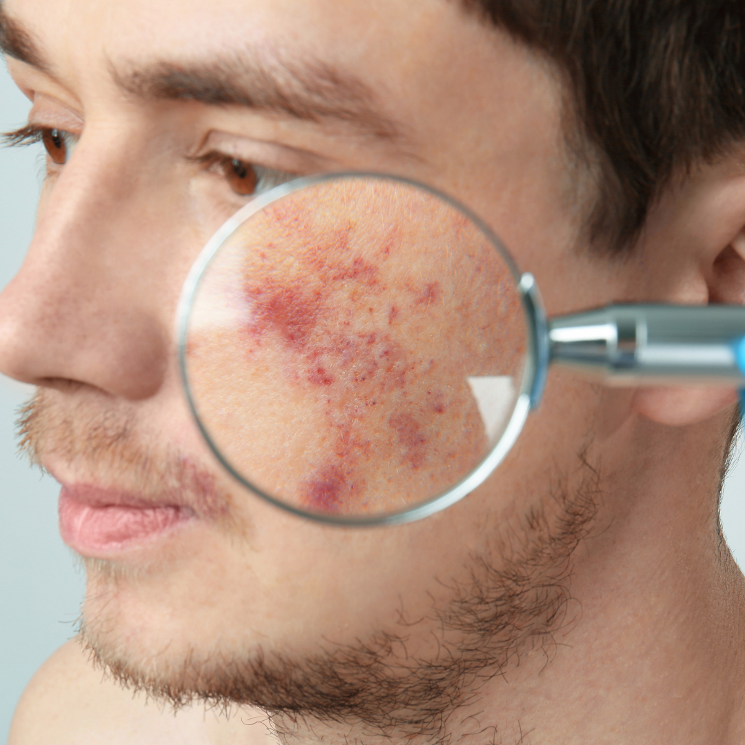 Does Birthmark removal leave Scars?