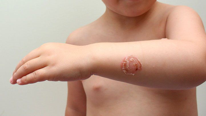 Impetigo Scars: Causes and How to Treat the Scarring