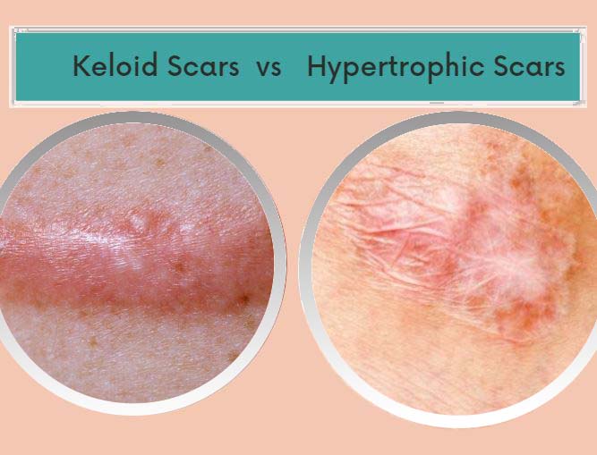hypertrophic scar vs keloid