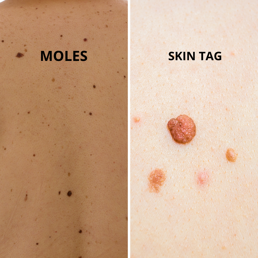 Moles vs. Skin Tag