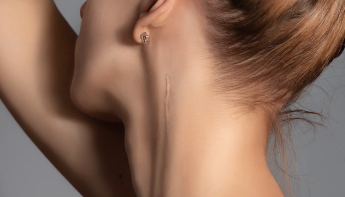 Scar Revision: Effective Ways to Eliminate Scars