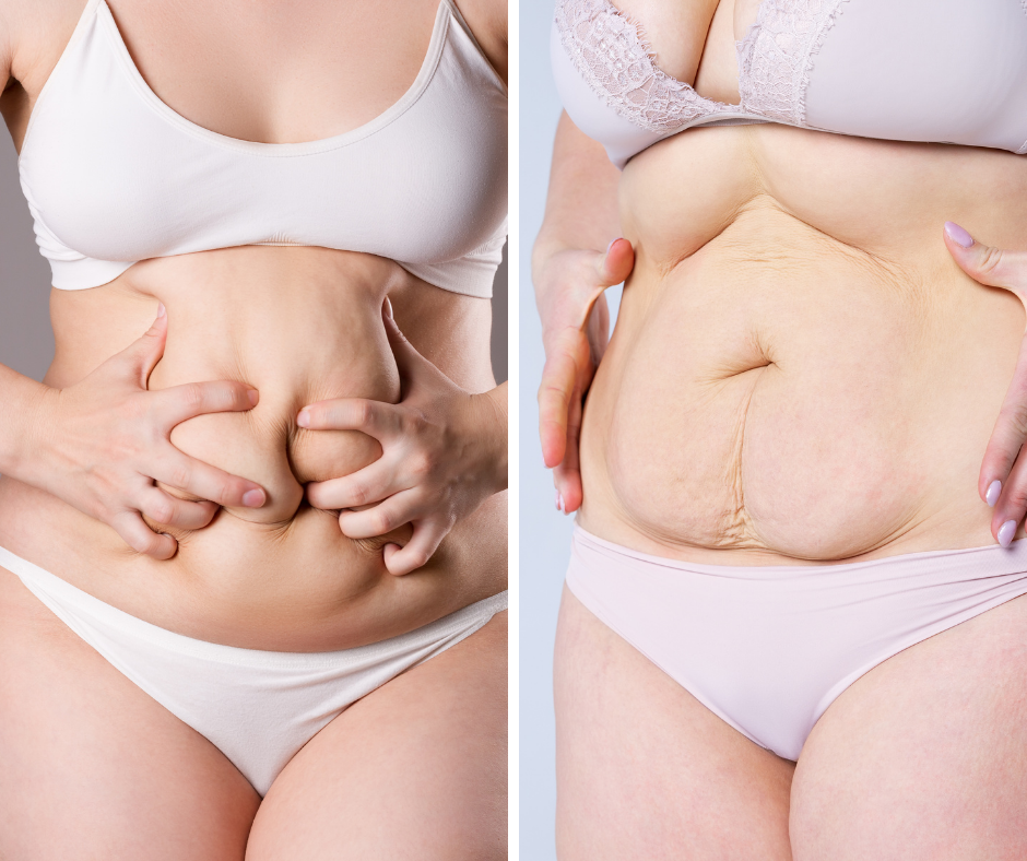 Tummy Tuck Scars: The Best Way to Treat Them - AWD Med